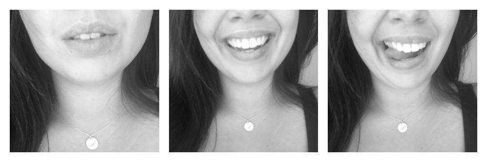 SmilePod-aesthetics-lip-fillers-teeth-whitening